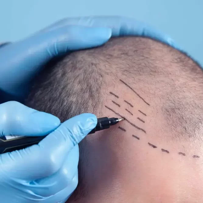 istanbul_hair_clinic