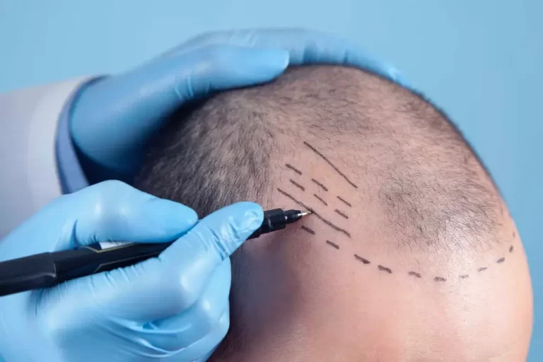 istanbul_hair_clinic